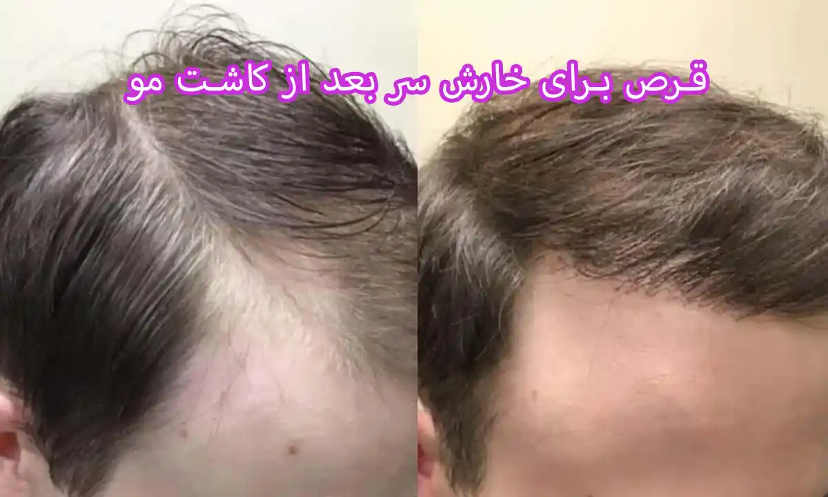 قرص برای خارش سر بعد از کاشت مو