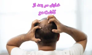 خارش سر بعد از کاشت مو