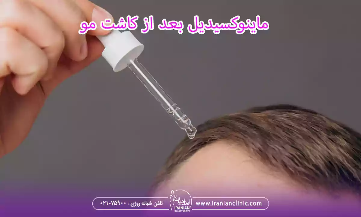 ⁠ماینوکسیدیل بعد از کاشت مو