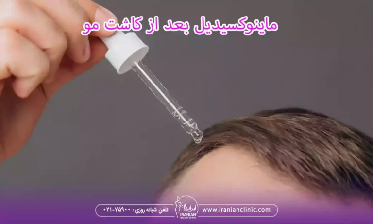 ⁠ماینوکسیدیل بعد از کاشت مو