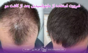 ضرورت استفاده از ماینوکسیدیل بعد از کاشت مو