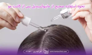نحوه استفاده صحیح از ماینوکسیدیل پس از کاشت مو