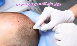کاشت مو بدون جراحی چیست