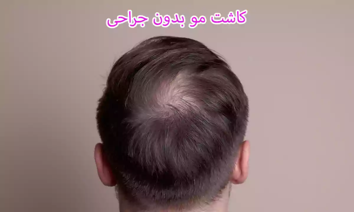 روش های کاشت مو بدون جراحی