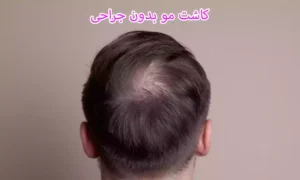 روش های کاشت مو بدون جراحی