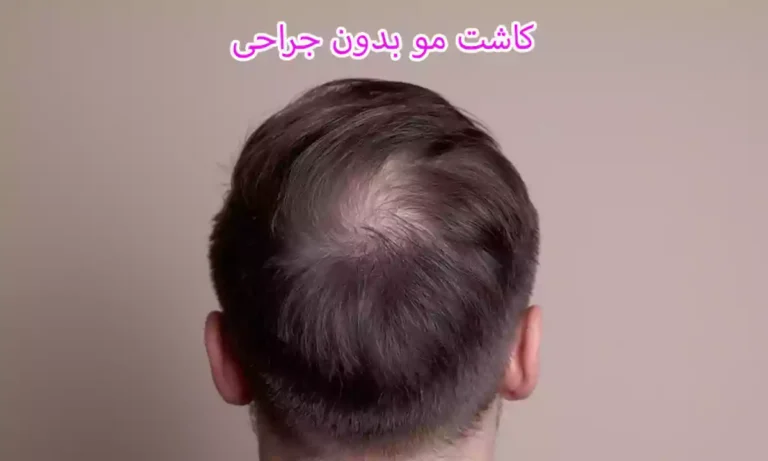 روش های کاشت مو بدون جراحی