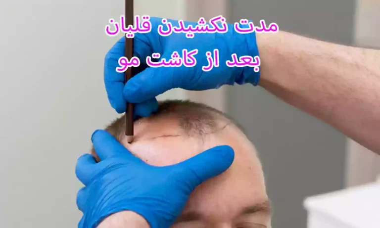 مدت نکشیدن قلیان بعد از کاشت مو