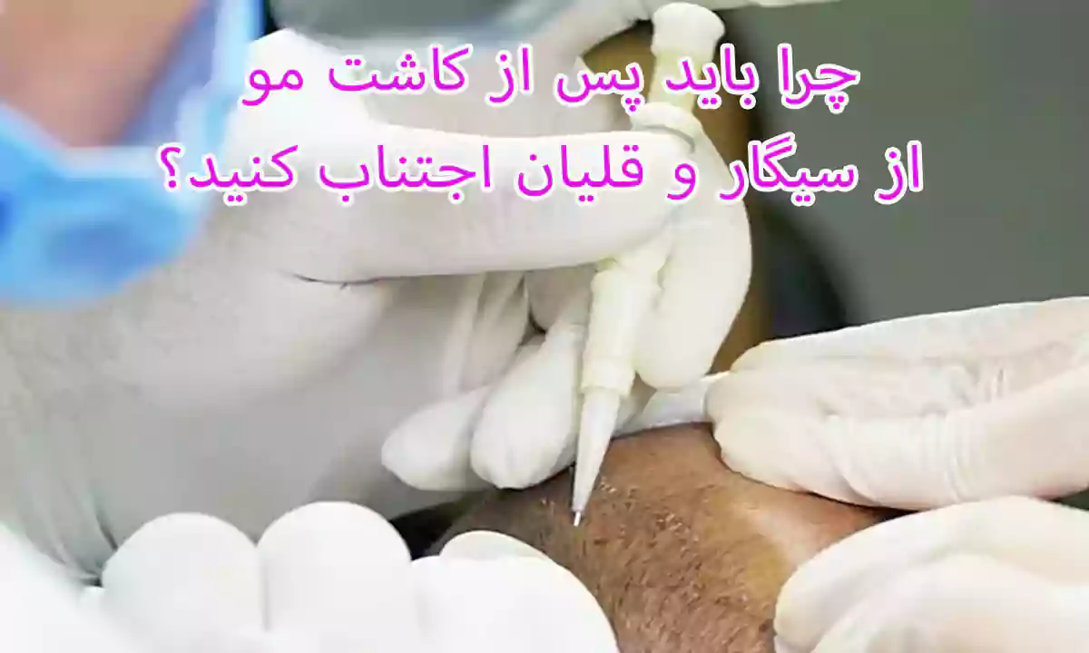 چرا باید پس از کاشت مو از سیگار و قلیان اجتناب کنید؟