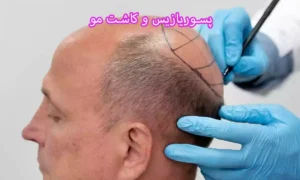 پسوریازیس و کاشت مو