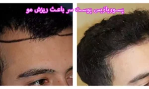 آیا پسوریازیس پوست سر باعث ریزش مو می شود؟