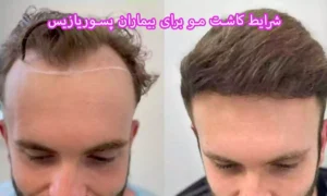 شرایط کاشت مو برای بیماران پسوریازیس پوست سر