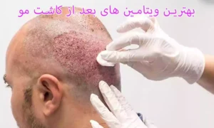 آیا درمان قطعی ریزش مو مصرف ویتامین بعد از کاشت مو است؟ بهترین ویتامین های بعد از کاشت مو