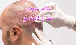 علائم عفونت بعد از کاشت مو