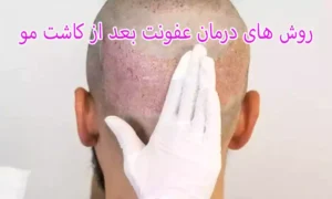 روش های درمان عفونت بعد از کاشت مو
