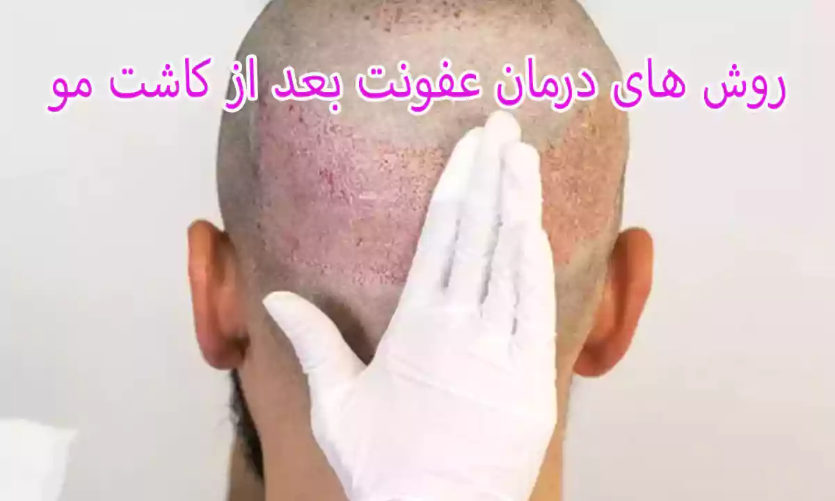 روش های درمان عفونت بعد از کاشت مو