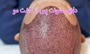 دلایل عفونت پس از کاشت مو