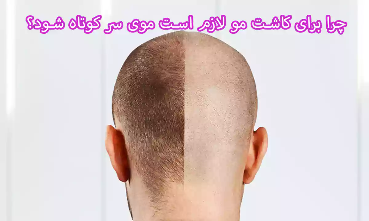 چرا برای کاشت مو لازم است موی سر کوتاه شود؟
