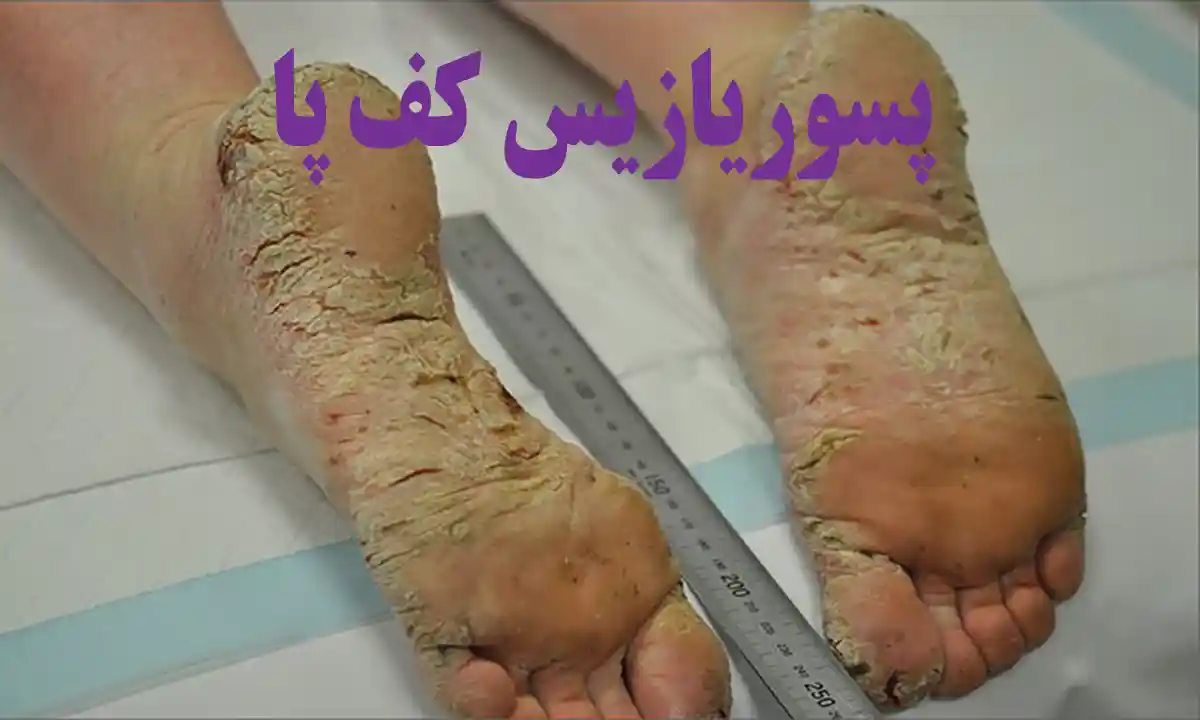 پسوریازیس کف پا