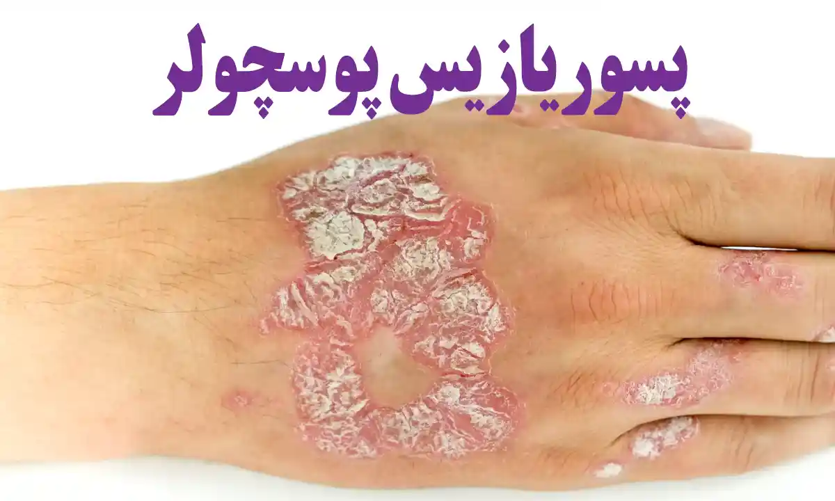پسوریازیس پوسچولر
