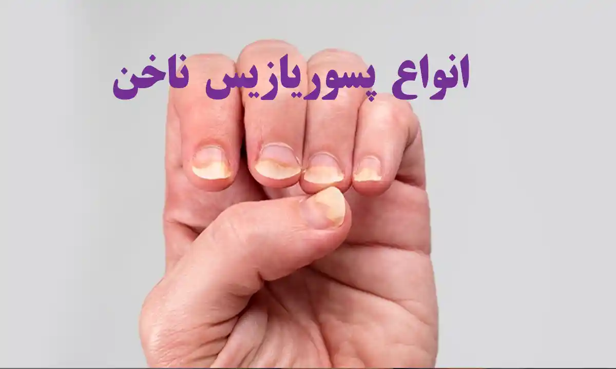 انواع پسوریازیس ناخن