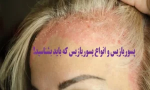 پسوریازیس و انواع پسوریازیس