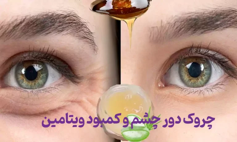 کمبود سه ویتامین که باعث چروک دورچشم می شود