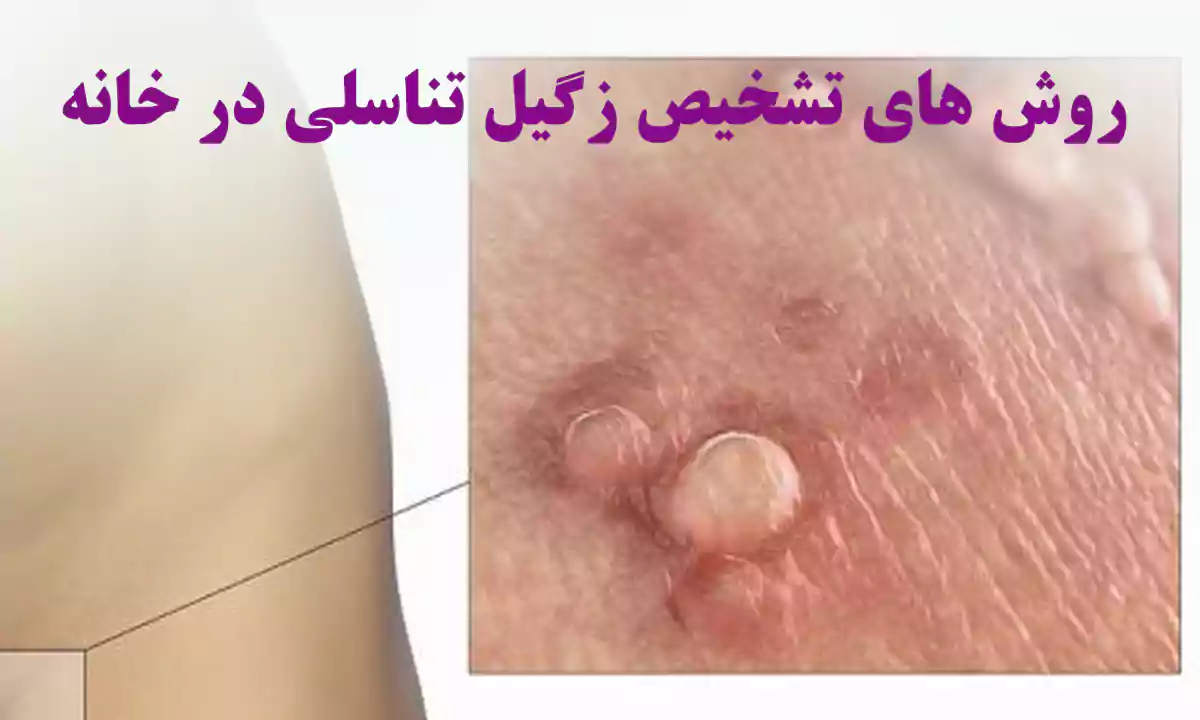 روش های تشخیص زگیل تناسلی در خانه
