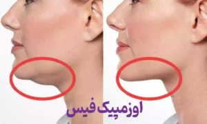 صورت اوزمپیک و اوزمپیک فیس چیست؟