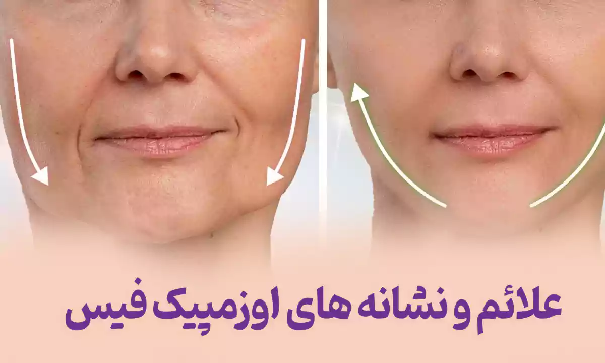 علائم و نشانه های اوزمپیک فیس