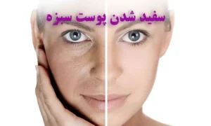 سفید شدن دائمی پوست سبزه با ۱۰ روش خانگی