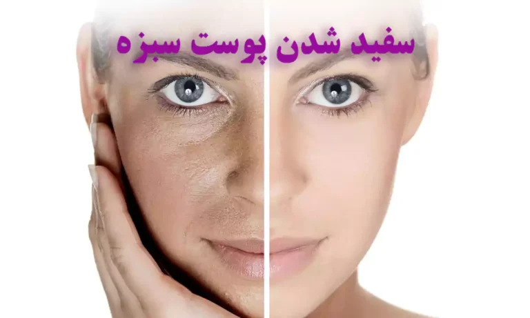 سفید شدن دائمی پوست سبزه با ۱۰ روش خانگی