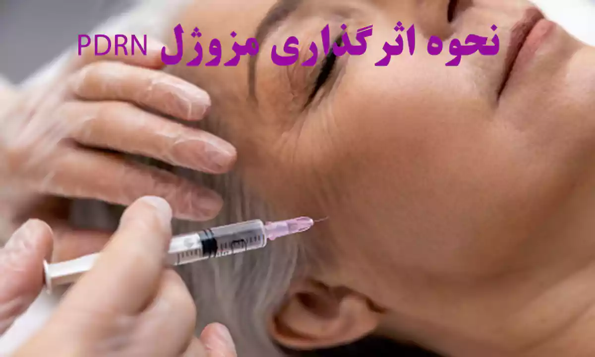 نحوه اثرگذاری مزوژل PDRN