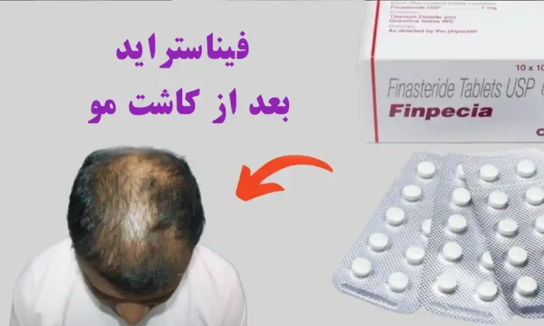 چرا مصرف فیناستراید بعد از کاشت مو موثر است؟