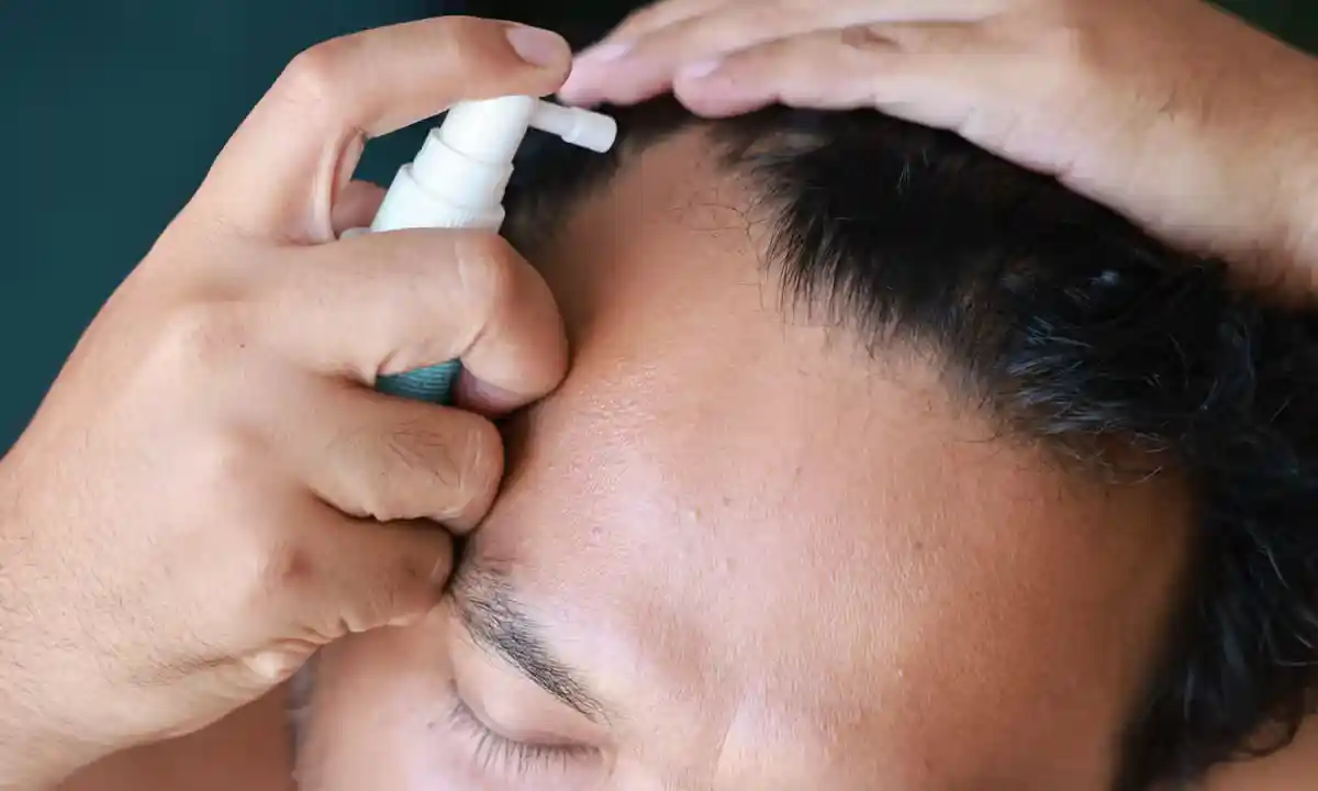فیناستراید برای ریزش مو با الگوی مردانه