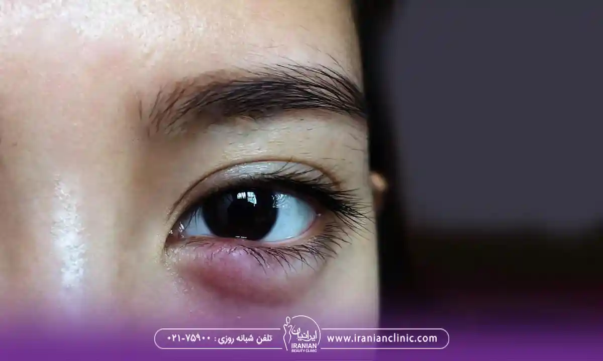 ورم زیر چشم به دلیل گل مژه
