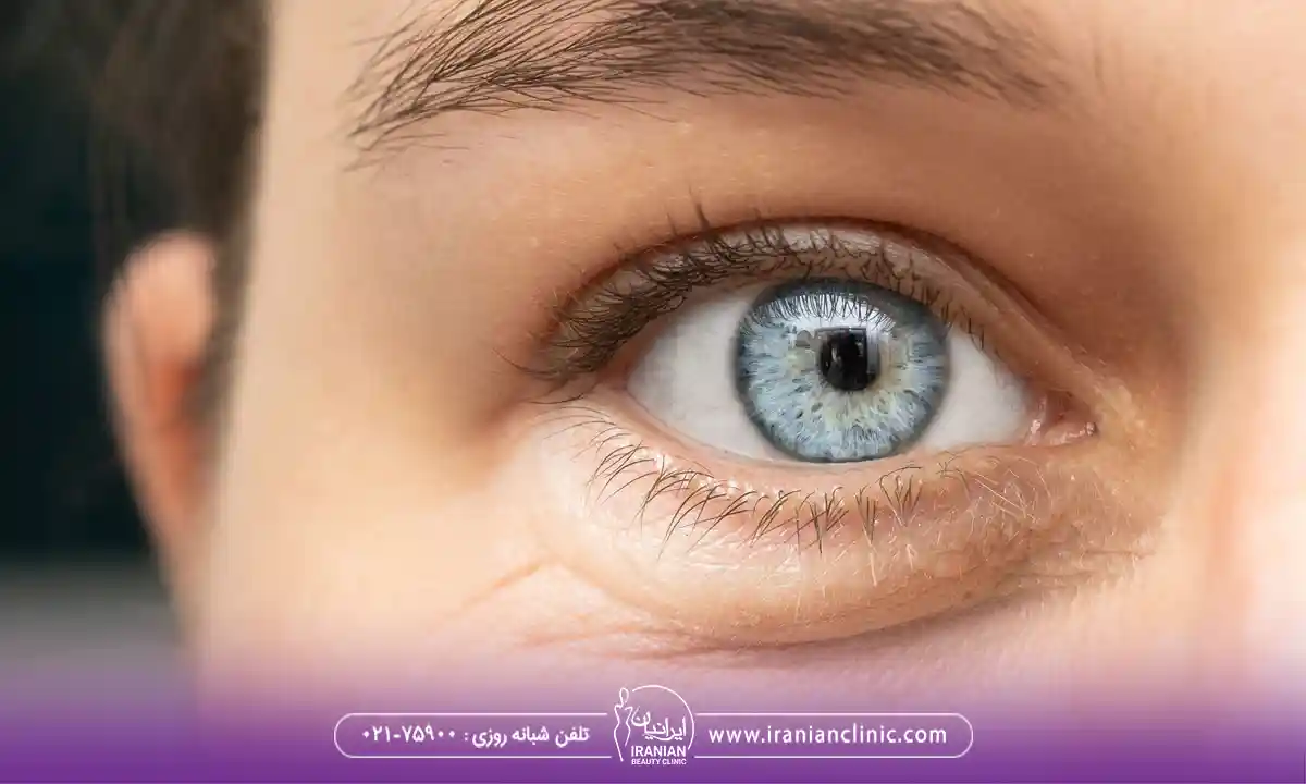 برداشتن پف زیر چشم بدون جراحی