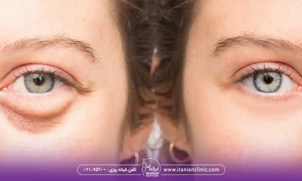 ورم زیر چشم چیست؟