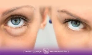 علت ورم ناگهانی زیر چشم؟