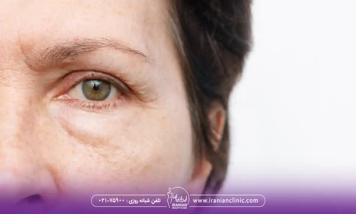 ورم ناگهانی زیر چشم با آلرژی های تنفسی