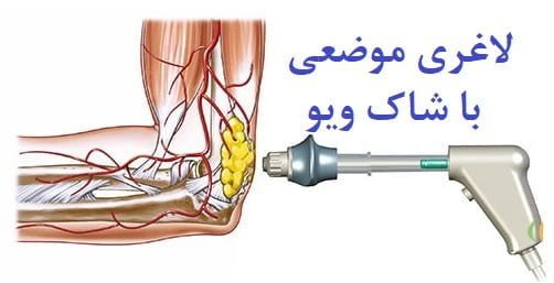 شاک ویو