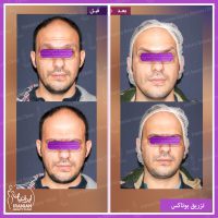 نمونه کار بوتاکس در کلینیک ایرانیان