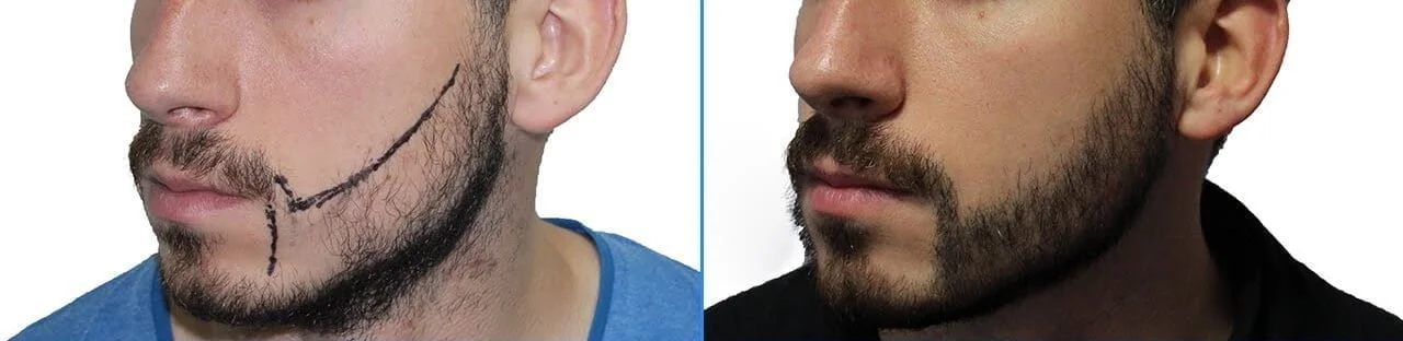 کاشت ریش و سیبیل
