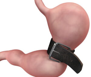 Gastric sleeve