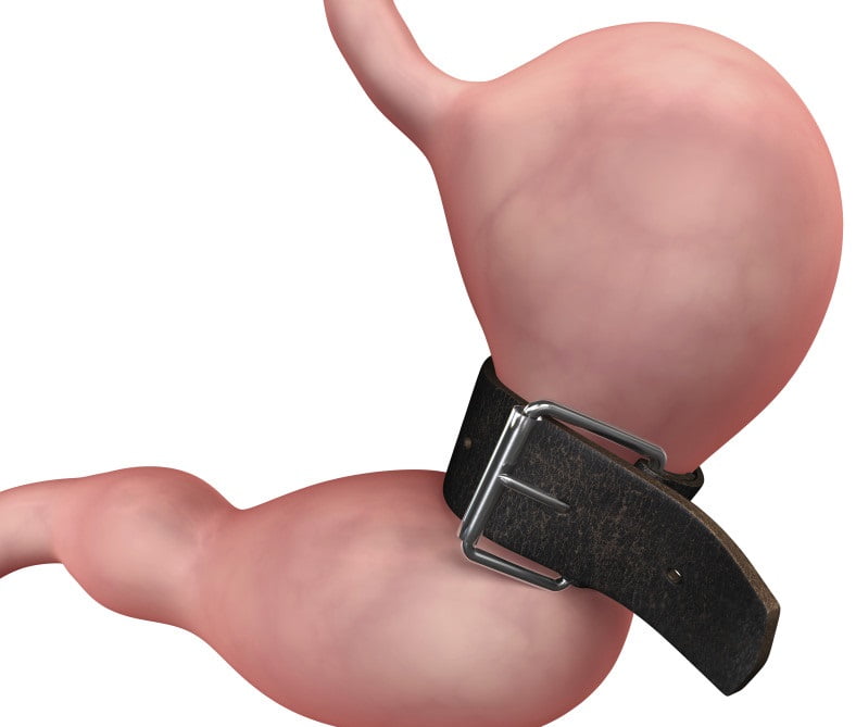 Gastric sleeve