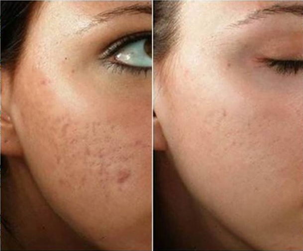 سابسیژن و نقش آن در جوانسازی پوست