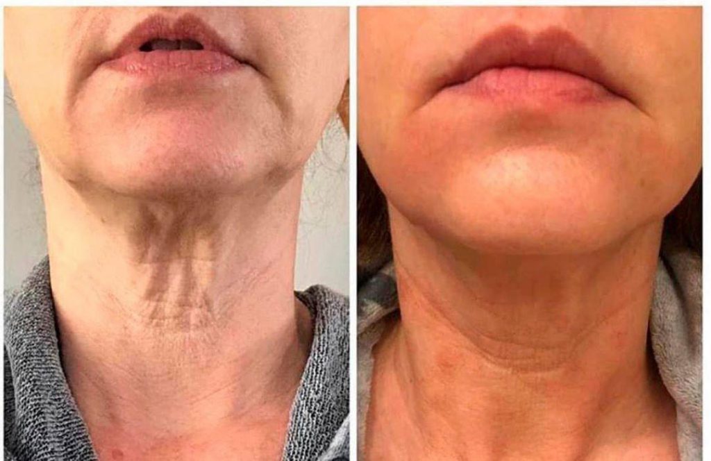 دستگاه اندولیفت | گروه کلینیک‌های زیبایی ایرانیان