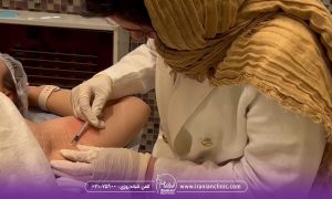 از بین بردن عرق زیر بغل با بوتاکس