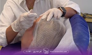 نقش بوتاکس در رفع سردرد‌های میگرنی چیست؟