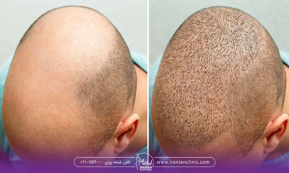 تصویر قبل و بعد کاشت موی سر - بهترین زمان کاشت مو