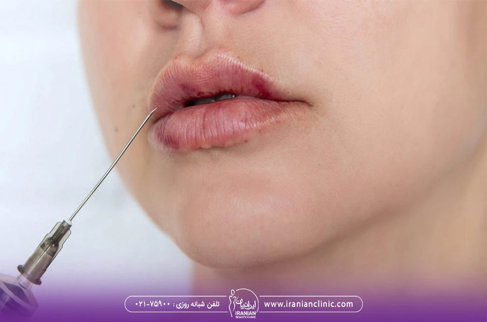 لب های کبود یک دختر که سرنگ کنار لب بالای او قرار گرفته است